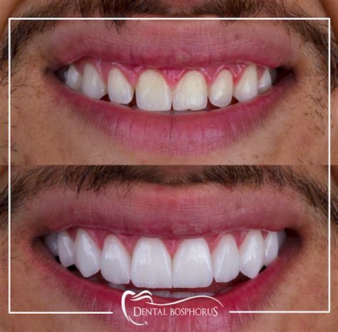 what are the cheapest veneers
